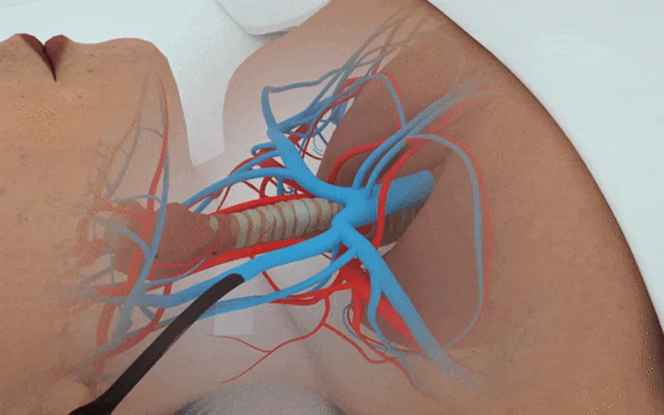 Texas Children's Hospital — ECMO